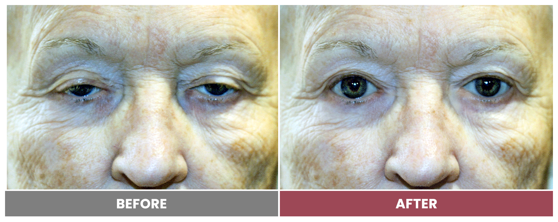 PTOSIS REPAIR - Case 41